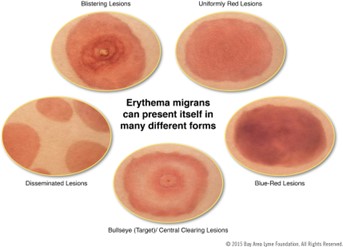 Presentations of Rash