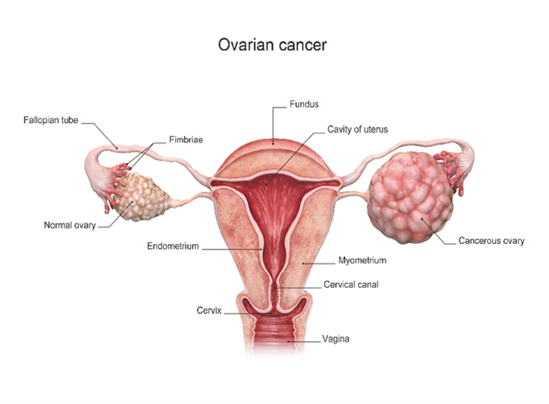 PEH_Ovarian